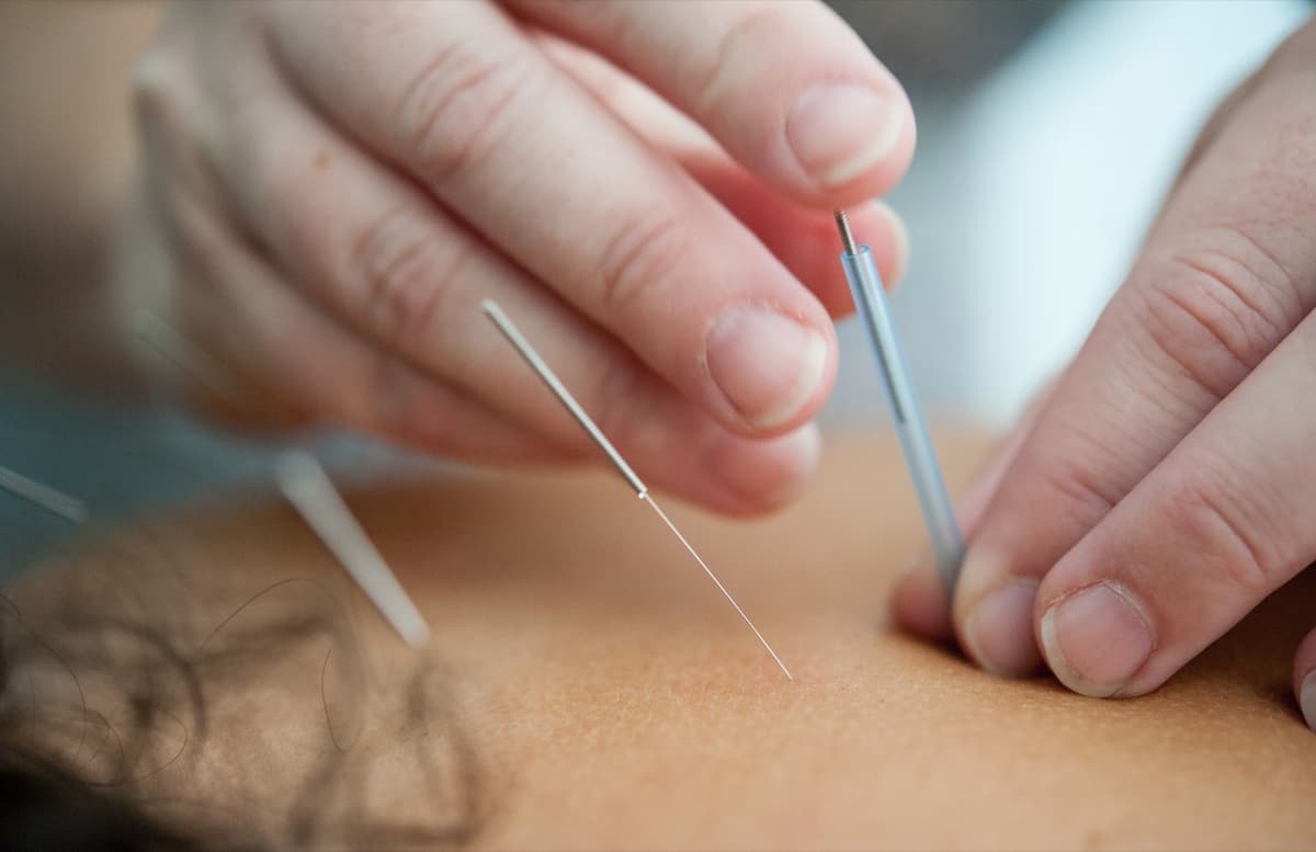 Dry Needling therapy being performed on a patient