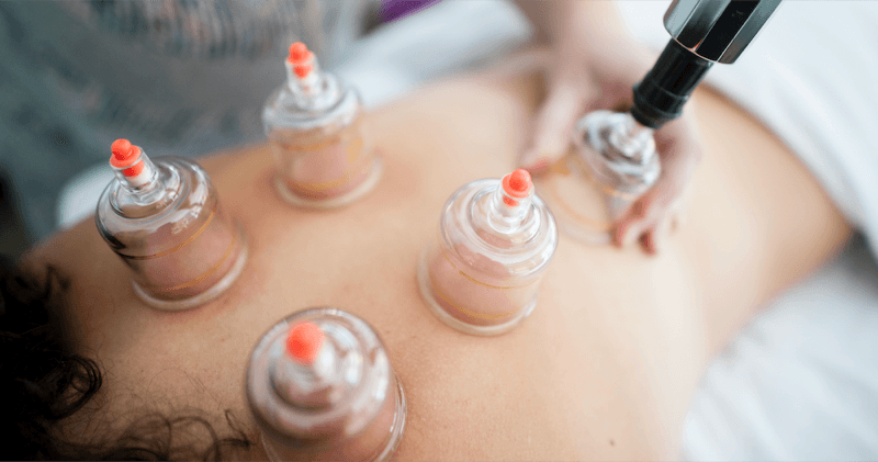 Functional cupping therapy being applied during a physical therapy session