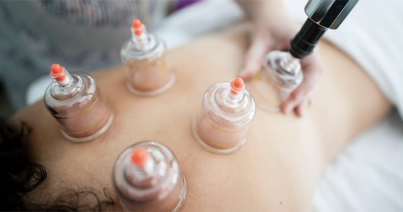 Physical therapist applying cupping therapy to a patient's back